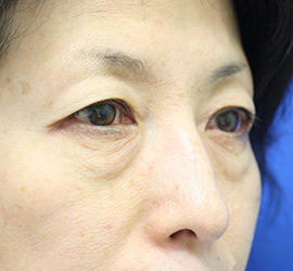 50代女性の下まぶたのたるみ取り After 症例写真