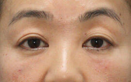 40代女性のヒアルロン酸注射(目の下) After 症例写真