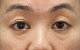 40代女性のヒアルロン酸注射(目の下) Before 症例写真