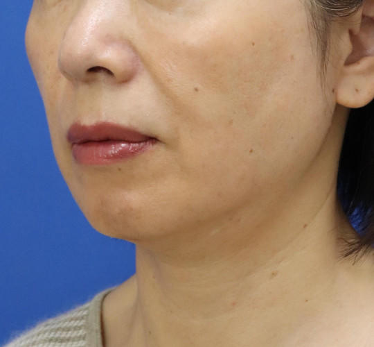 50代女性の顔の脂肪吸引 After 症例写真