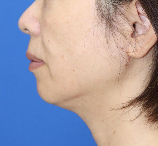 50代女性の顔の脂肪吸引  After 症例写真