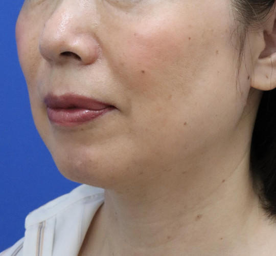 50代女性の顔の脂肪吸引 Before 症例写真