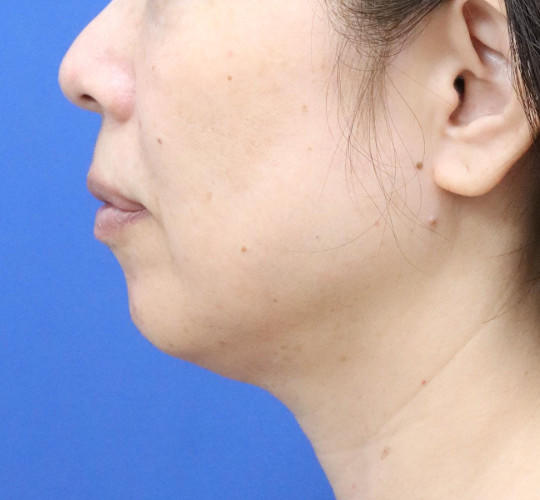 50代女性の顔の脂肪吸引  Before 症例写真