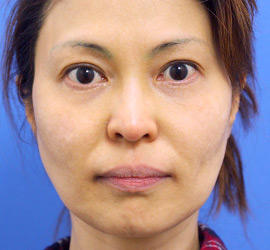 40代女性のレーザートーニング After 症例写真