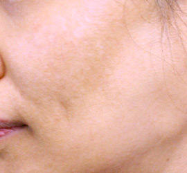 40代女性のレーザートーニング After 症例写真