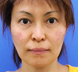 40代女性のレーザートーニング Before 症例写真