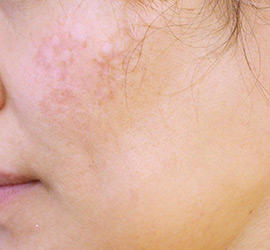 40代女性のレーザートーニング Before 症例写真