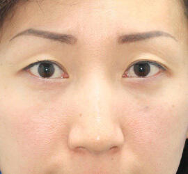 30代女性の目の下のクマ治療 After 症例写真