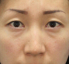 30代女性の目の下のクマ治療 Before 症例写真