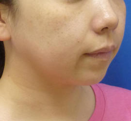 40代女性のサーマクール After 症例写真