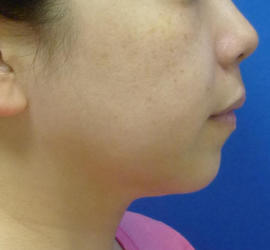 40代女性のサーマクール After 症例写真