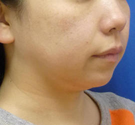 40代女性のサーマクール Before 症例写真