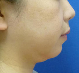 40代女性のサーマクール Before 症例写真