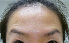 40代女性のボトックス（シワ取り） After 症例写真