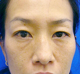 40代女性の上まぶたのたるみ取り Before 症例写真