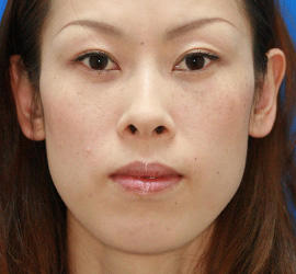 30代女性のシミ・そばかす After 症例写真