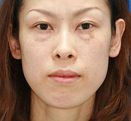 30代女性のシミ・そばかす Before 症例写真