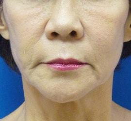 60代女性のヒアルロン酸注射  After 症例写真