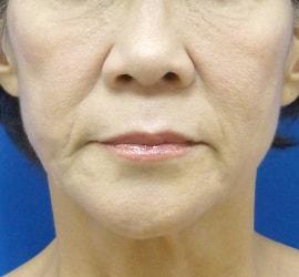 60代女性のヒアルロン酸注射  Before 症例写真