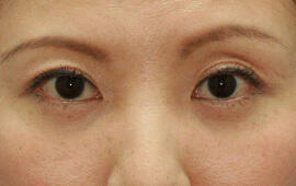 40代女性の目の下のクマ治療 After 症例写真