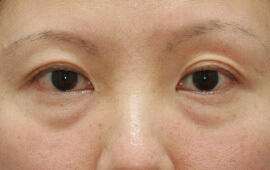 40代女性の目の下のクマ治療 Before 症例写真