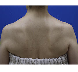 40代女性のボトックス（美肩・肩こり解消） After 症例写真