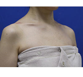 40代女性のボトックス（美肩・肩こり解消） After 症例写真