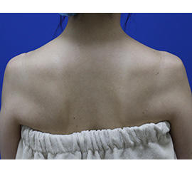 40代女性のボトックス（美肩・肩こり解消） Before 症例写真