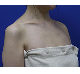 40代女性のボトックス（美肩・肩こり解消） Before 症例写真