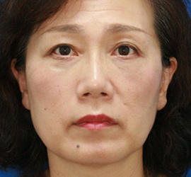 50代女性の下まぶたのたるみ取り After 症例写真