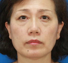 50代女性の下まぶたのたるみ取り Before 症例写真