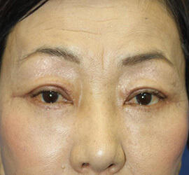 60代女性のシワ・たるみ After 症例写真