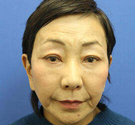 60代女性の下まぶたのたるみ取り After 症例写真