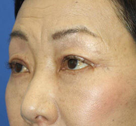 60代女性の下まぶたのたるみ取り After 症例写真