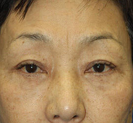 60代女性のシワ・たるみ Before 症例写真