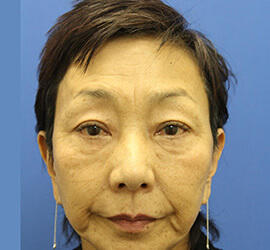 60代女性の下まぶたのたるみ取り Before 症例写真