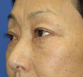 60代女性の下まぶたのたるみ取り Before 症例写真