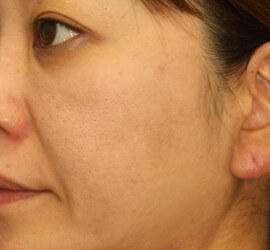 40代女性の Before 症例写真