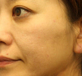 40代女性の After 症例写真