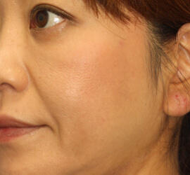 40代女性のシワ・たるみ After 症例写真