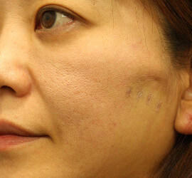 40代女性の Before 症例写真