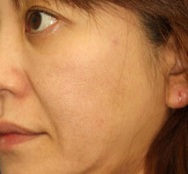 40代女性のシワ・たるみ Before 症例写真