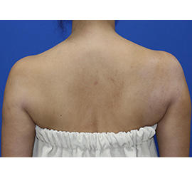 40代女性のボトックス（美肩・肩こり解消） After 症例写真