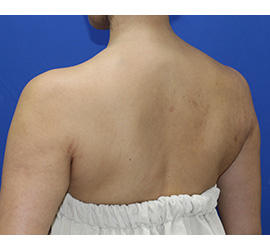 40代女性のボトックス（美肩・肩こり解消） After 症例写真