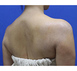 40代女性のボトックス（美肩・肩こり解消） After 症例写真