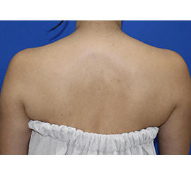 40代女性のボトックス（美肩・肩こり解消） Before 症例写真