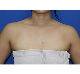 40代女性のその他 Before 症例写真