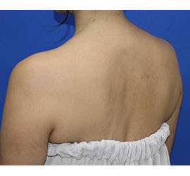 40代女性のボトックス（美肩・肩こり解消） Before 症例写真