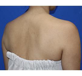 40代女性のボトックス（美肩・肩こり解消） Before 症例写真