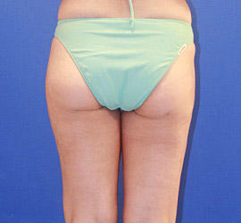 30代女性の脂肪吸引 After 症例写真